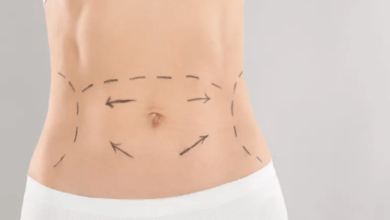 Abdominoplasty