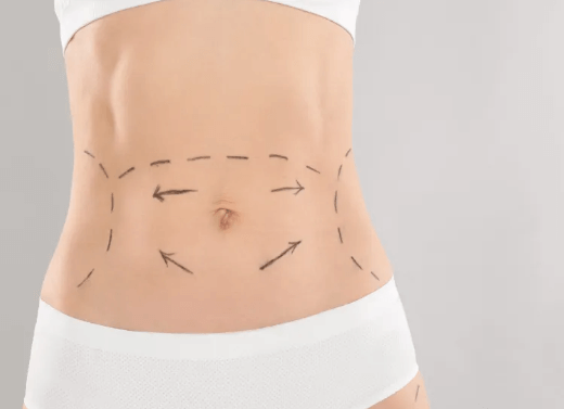 Abdominoplasty