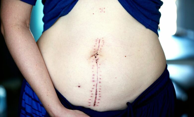 thyroidectomy surgery information queries